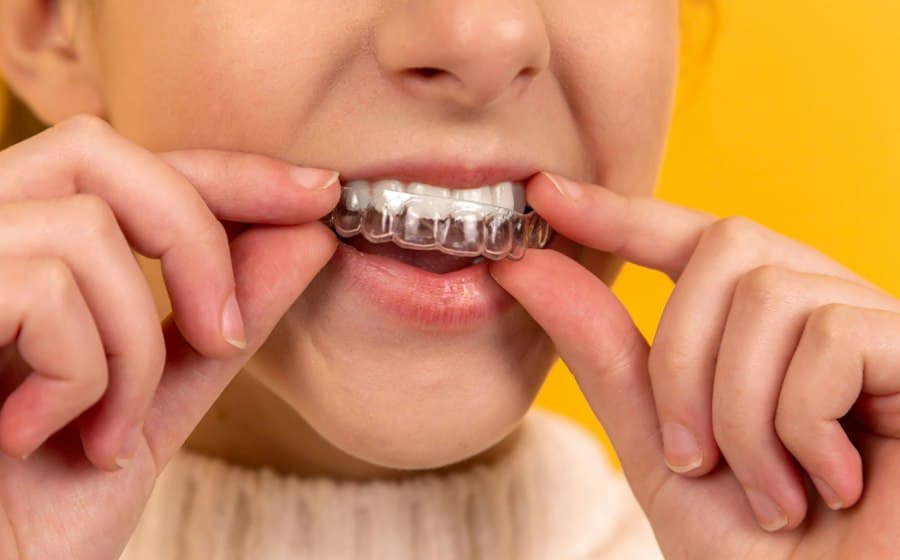Pessoa encaixando um alinhador dental transparente